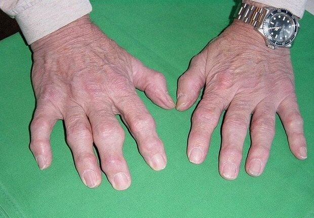 Osteoarthritis of the fingers