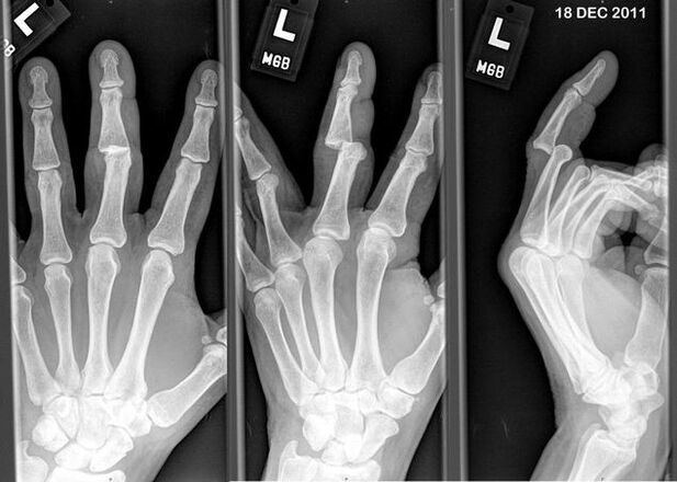 Radiography of displaced fingers