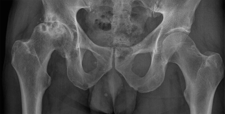 Deforming arthrosis of the hip joint on x-ray