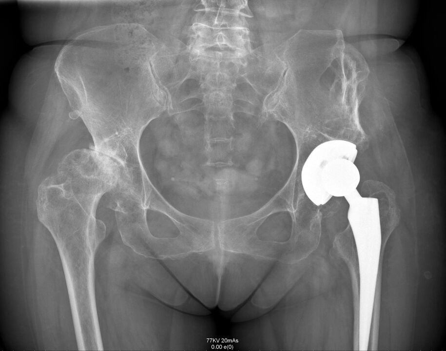 X-ray of the hip joint after arthroplasty