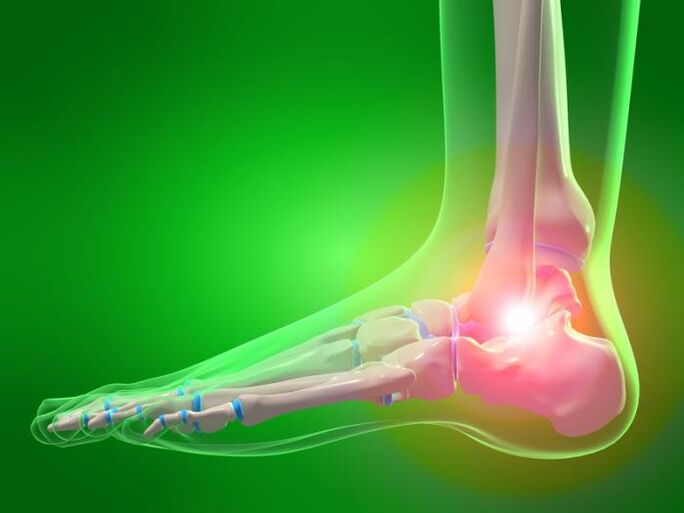 inflammation of the ankle joint with arthrosis