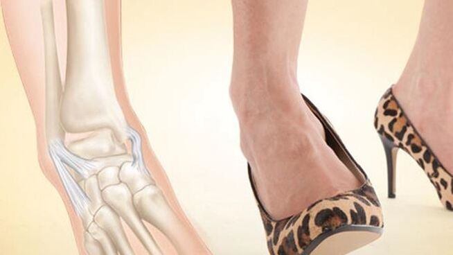 wearing high-heeled shoes as a cause of ankle arthrosis