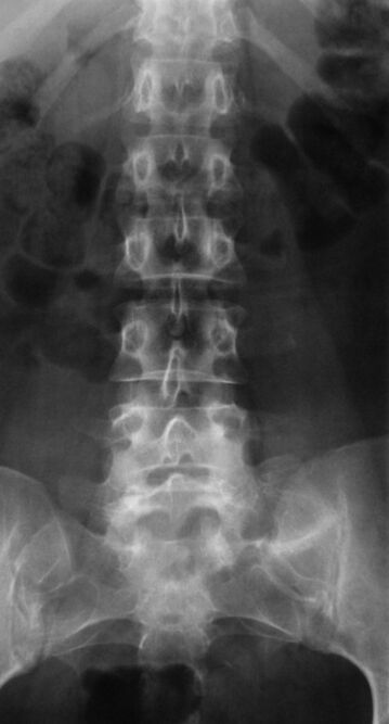 In order to diagnose lumbar osteochondrosis, X-ray is performed