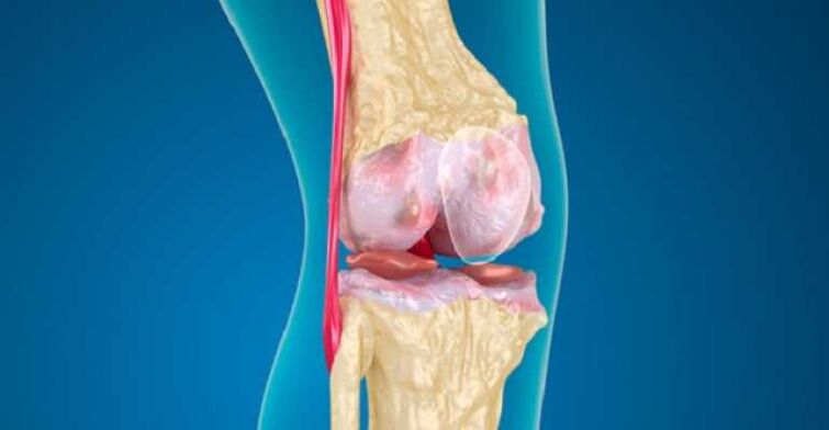 Arthrosis of the knee joint disease, which causes the cartilage to destroy in the joints