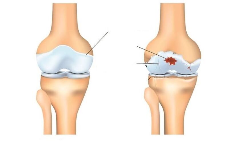 Healthy and patient with arthrose joints