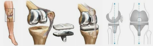 Endoprosthesis for example the knee